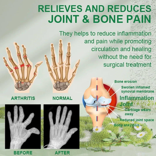 Bee Venom Pain Relief Cream – Ultra Strength with Manuka Honey | Fast-Acting Relief for Joint & Muscle Pain | Anti-Inflammatory Formula – 2 x 50g Tubes (Pack of 2)